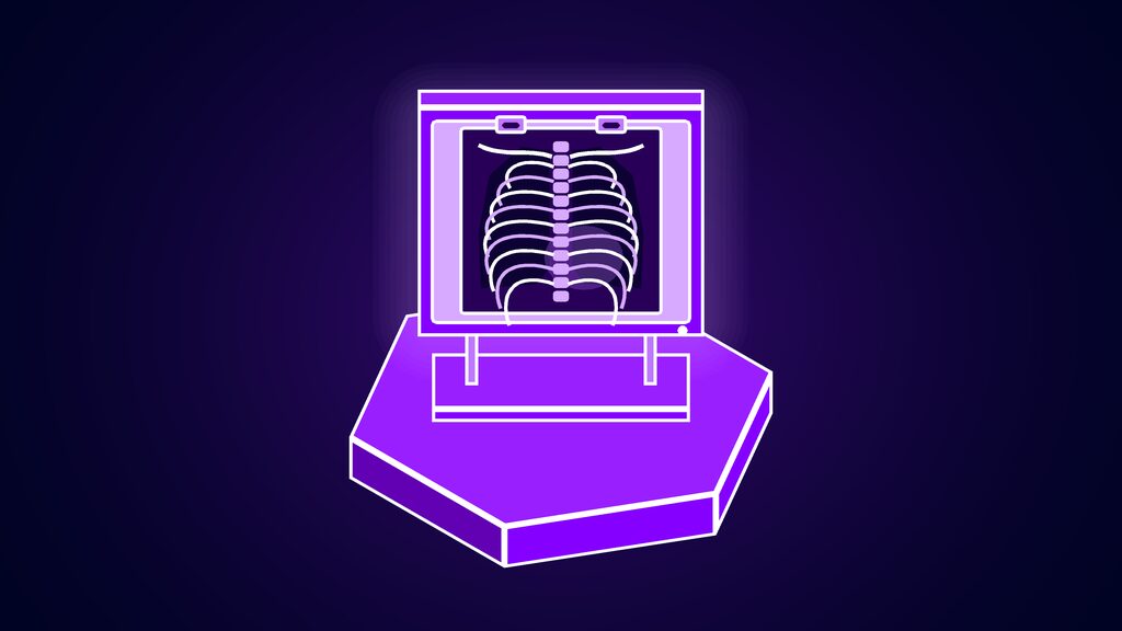 palantir nhs contract uk fears health service deal a x ray lightbox showing a ribcage film